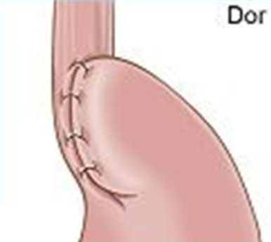 Dorr Fundoplication